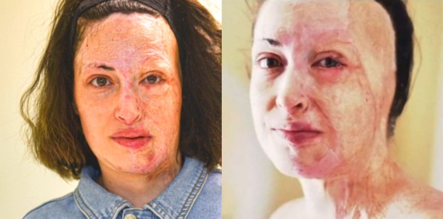 Σαν να μην έγινε ποτέ η Επίθεση: Η Ιωάννα Παλιοσπύρου έκρυψε τα Σημάδια στο Πρόσωπό της με μακιγιάζ και χαμογελά ξανά (Pics)