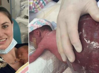 «Μωρό θαύμα» γεννήθηκε πρόωρα με έναν όγκο διπλάσιο από το μέγεθός του