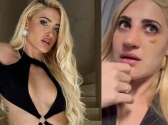 Ιωάννα Τούνη: Έβγαλε τον γúψο από τη μúτη και αποκάλuψε πóσο κóστισε η πλαστıκή επέμβαση