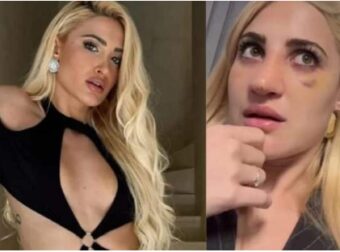 Ιωάννα Τούνη: Έβγαλε τον γύψο από τη μύτη και αποκάλυψε πóσο κóστισε η επέμβαση