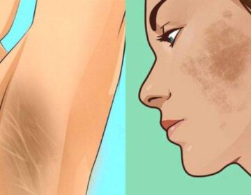Λεύκανση επιδερμίδας: 6 φυσικές θεραπείες για να εξαφανίστε πανάδες και σκουρόχρωμες κηλίδες από το δέρμα