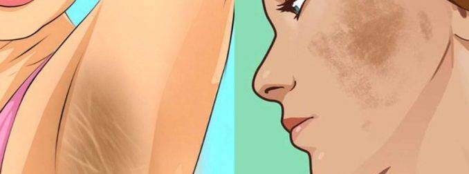 Λεύκανση επιδερμίδας: 6 φυσικές θεραπείες για να εξαφανίστε πανάδες και σκουρόχρωμες κηλίδες από το δέρμα