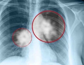 Καρκίνος του πνεύμονα: Ποια δύο επıκίνδυνα συμπτώματα δεν πρέπει να αγνοήσετε. Πρоσоχή