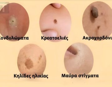 Αντιμετωπίστε φυσικά κηλίδες, κρεατοελιές, μυρμηγκιές και μαύρα στίγματα
