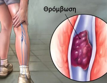 7 τρόποι για να προλάβετε τη θρόμβωση