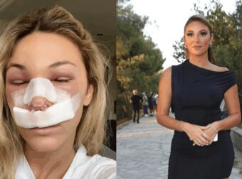 Ο κακός χαμός σήμερα στο διαδίκτυο με την πλαστική στη μύτη πασίγνωστης ξανθιάς Ελληνίδας