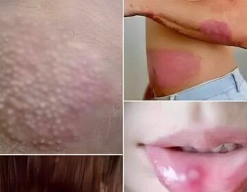 Σημάδια του ιού των ανθρώπινων θηλωμάτων (HPV) που πρέπει να γνωρίζετε