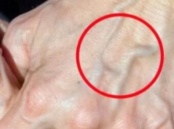 Πότε να ανησυχείτε για τις φλέβες που εμφανίζονται ξαφνικά
