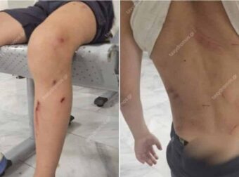 Βόλος: Στο νοσοκομείο 7χρονος μετά από επίθεση σκυλιών – «Παραλίγο να το κατασπαράξουν» λέει η μητέρα του