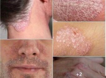 Πάσχετε από ψωρίαση; Ανακαλύψτε τι κρύβεται πίσω από αυτήν την πάθηση και πώς να την διαχειριστείτε