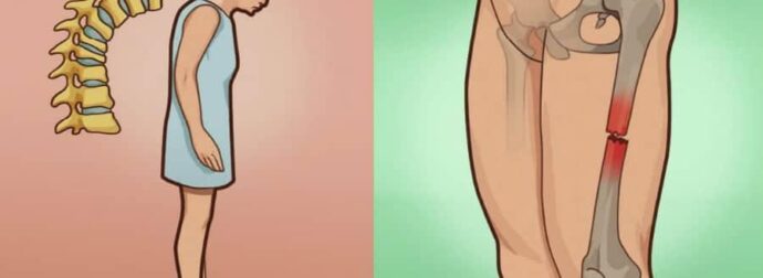 Οστεοπόρωση: Το ελληνικό βότανο που δυναμώνει και προστατεύει τα κόκκαλα