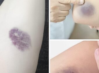 ΠΡΟΣΟΧΗ! Αν εμφανιστούν τέτοιες μελανιές στο σώμα σας, σημαίνει ότι έχετε…