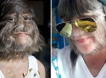 Το πιο τριχωτό κορίτσι στο κόσμο ξυρίστηκε γιατί βρήκε τον έpωτα της ζωή της