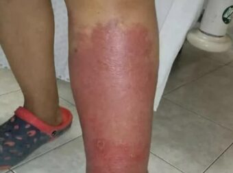 Σημάδια στα πόδια σας – Όλα όσα πρέπει να γνωρίζετε για το πρήξιμο