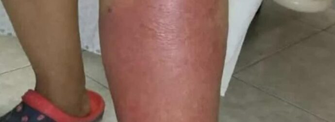 Σημάδια στα πόδια σας – Όλα όσα πρέπει να γνωρίζετε για το πρήξιμο