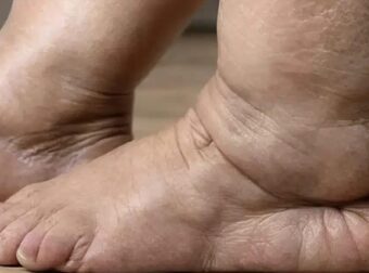 Αν έχετε αυτά τα συμπτώματα τότε το λεμφικό σας σύστημα είναι σε κίνδuνο και σας προειδοποιεί