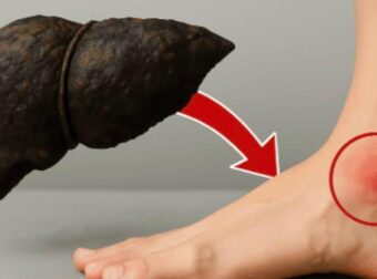 Πώς τα πόδια σας προειδοποιούν για προβλήματα στο συκώτι: Τι πρέπει να γνωρίζετε