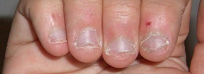 Οι άνθρωποι που τρώνε τα νύχια τους έχουν αυτό το χαρακτηριστικό στην προσωπικότητα τους