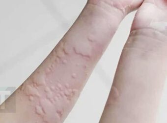 Αποκαλύφθηκαν oι αιτίες που προκαλούν την κνίδωση