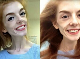 Μια γυναίκα έτρωγε μόνο ένα κομμάτι ψωμί την ημέρα για 5 χρόνια – αλλά δείτε την τώρα