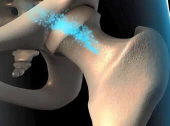 Το φρούτο που προλαμβάνει την οστεοπόρωση – Ποια είναι η ιδανική ποσότητα