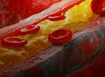 Αυτό είναι το καλύτερο φρούτο για να καθαρίσετε τις αρτηρίες σας και τις φλέβες σας