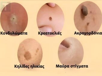 Αντιμετωπίστε φυσικά κηλίδες, κρεατοελιές, μυρμηγκιές και μαύρα στίγματα