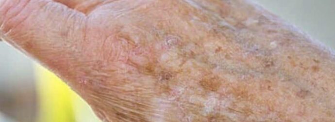 Γιατί εμφανίζονται κηλίδες στα χέρια μας και πώς μπορούμε να τις εξαλείψουμε;