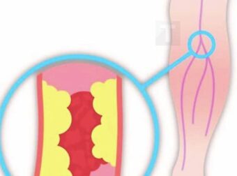 Τα 12 πιο σοβαρά συμπτώματα κακής κυκλοφορίας του αίματος στα πόδια