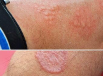 Πώς να μειώσετε τον ερεθισμό του δέρματος: Αίτιες, θεραπείες και συμβουλές πρόληψης