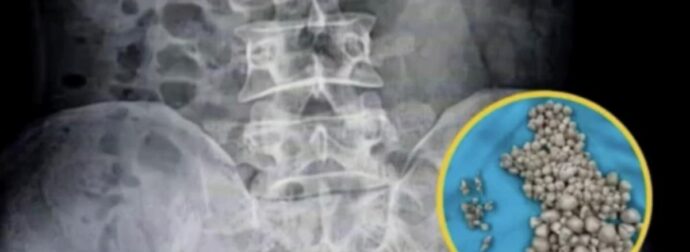 Οι γιατροί σοκαρίστηκαν αφού βρήκαν 300 πέτρες στα νεφρά σε νέα γυναίκα
