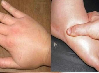 Απαλλαγείτε γρήγορα από τα πρησμένα χέρια και πόδια: Σπιτικές θεραπείες για την κατακράτηση υγρών