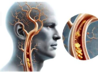 1 βιταμίνη σταματά τη συσσώρευση ασβεστίου στις αρτηρίες και την καρδιά