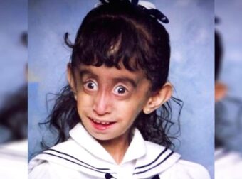 Την αποκαλούσαν "Η πιο άσχημη γυναίκα του κόσμου". Τώρα εμπνέει εκατομμύρια ανθρώπους