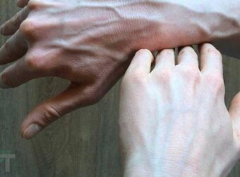 Αν δείτε κάποιον με διογκωμένες φλέβες, πρέπει να του πείτε αυτά τα πράγματα