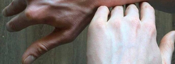 Αν δείτε κάποιον με διογκωμένες φλέβες, πρέπει να του πείτε αυτά τα πράγματα