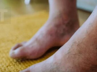 Τι κρύβεται πίσω από το μωβ χρώμα στα πόδια σας; Αιτίες που δεν πρέπει να αγνοήσετε