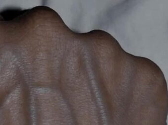 5 προβλήματα υγείας που μπορούν να προκαλέσουν ορατές φλέβες