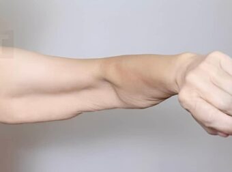 Σαρκοπενία: Αιτίες απώλειας μυϊκής μάζας και λύσεις