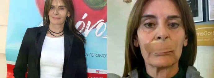 Πλουμιδάκη: Υποβλήθηκε στο 21ο χειρουργείο – «Πήραν λίπος από τον γλουτό για τη συγκεκριμένη επέμβαση»