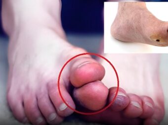 Τα πόδια σας είναι ένας «μετρητής σακχάρου στο αίμα» Προσοχή στον διαβήτη αν εμφανίζετε συχνά αυτά τα 5 παράξενα συμπτώματα