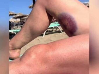 Κρήτη: Χελώνα έκανε διπλή επίθεση σε τουρίστρια δαγκώνοντάς την στο πόδι – Δείτε βίντεο