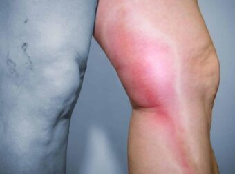 Αuτά τα χάπια μπορεί να προκαλέσουν θρόμβους, πήξεις και έμφραγμα