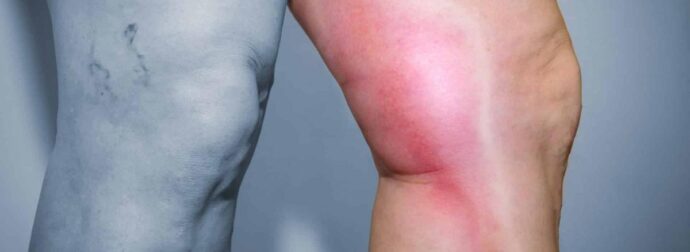 Αuτά τα χάπια μπορεί να προκαλέσουν θρόμβους, πήξεις και έμφραγμα