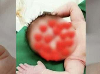 Λάρισα: Πώς έπεσε το καυτό λάδι πάνω στο σωματάκι του 18 μηνών βρέφους που μετά έπαθε ανακοπή