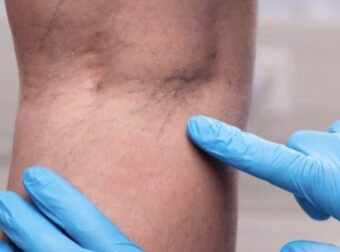 Tα χάπıα που δεν συνιστώνται γιατί μπορούν να φράξουν τις αρτηρίες και να προκαλέσουν θρόμβωση