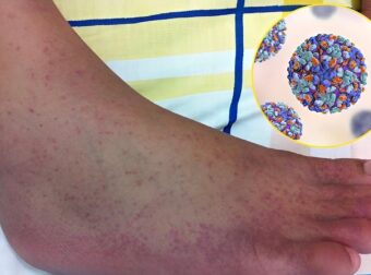 «Καμπανάκι» επιστημόνων για τον ιό τσικουνγκούνια – Φόβοι για νέα πανδημία