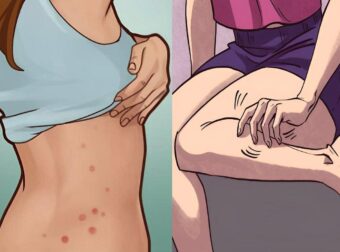 Φαγούρα στο σώμα: Πότε εμφανίζεται και τι σημαίνει για την υγεία μας