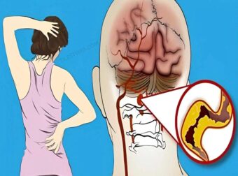 10 ασυνήθιστα σημάδια εγκεφαλικού στις γυναίκες