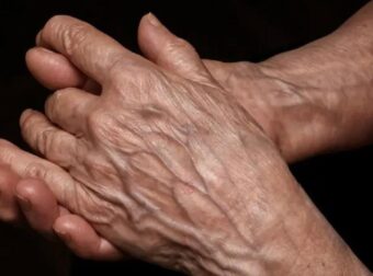 Ορατές φλέβες: Αιτίες, κίνδυνοι και πότε πρέπει να ανησυχήσετε